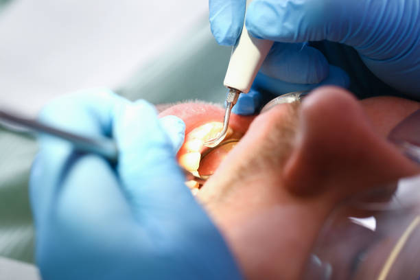 Best Emergency Dentist for Knocked-Out Tooth in Palm Beach Gardens, FL
